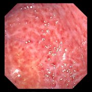 得了糜烂性胃炎该怎样治疗